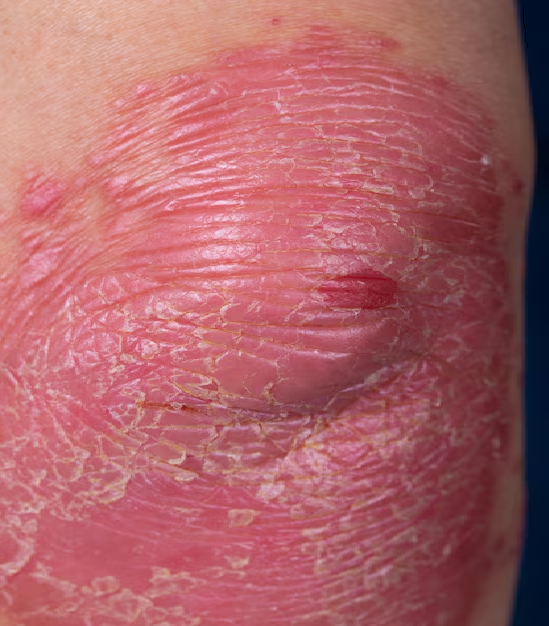 Close-up image showing psoriasis on a person's skin, with red, raised patches covered in white or silvery scales. The affected area appears inflamed and dry, highlighting the typical characteristics of plaque psoriasis.