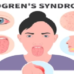 Sjogren’s Disease