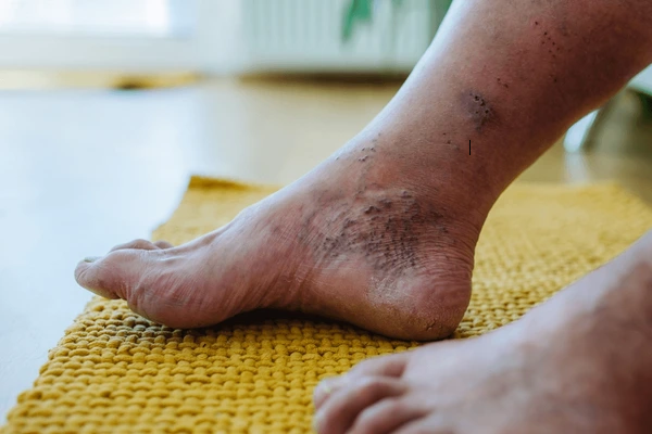 Image of a diabetic foot with visible ulcers and skin discoloration.