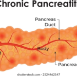 Chronic Pancreatitis