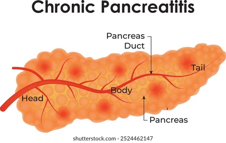 CHRONIC PANCREATITIS